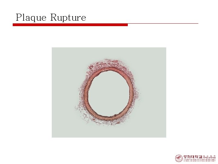 Plaque Rupture 