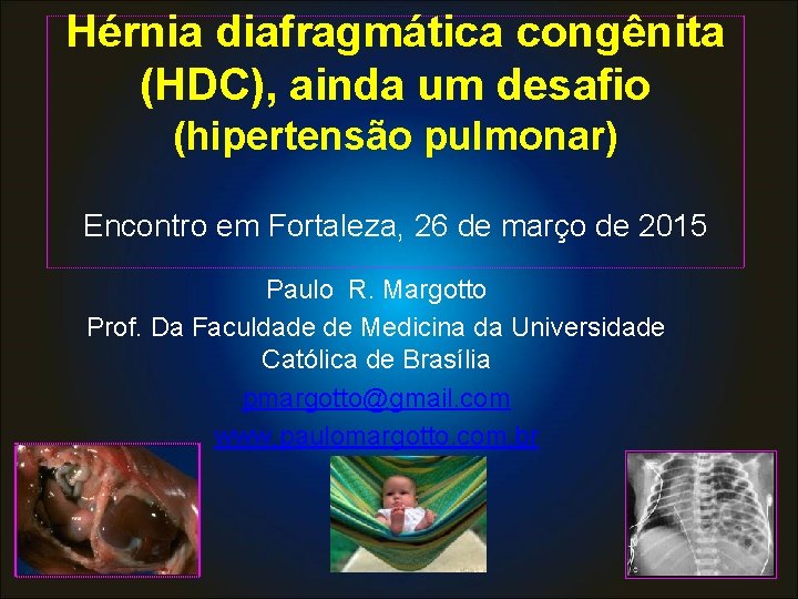 Hérnia diafragmática congênita (HDC), ainda um desafio (hipertensão pulmonar) Encontro em Fortaleza, 26 de