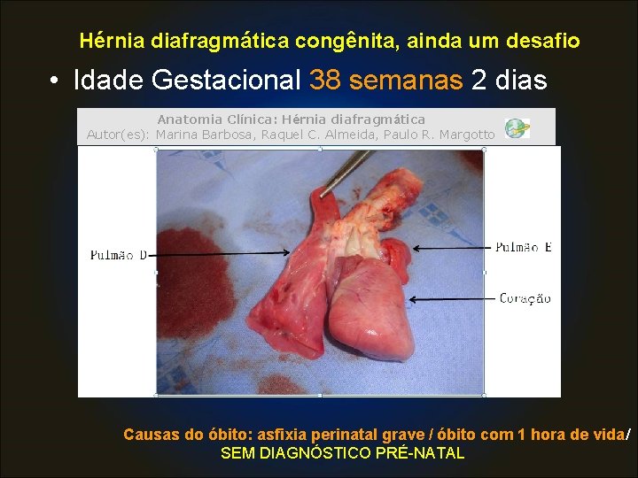 Hérnia diafragmática congênita, ainda um desafio • Idade Gestacional 38 semanas 2 dias Anatomia