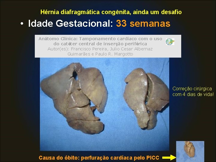 Hérnia diafragmática congênita, ainda um desafio • Idade Gestacional: 33 semanas Anátomo Clínica: Tamponamento