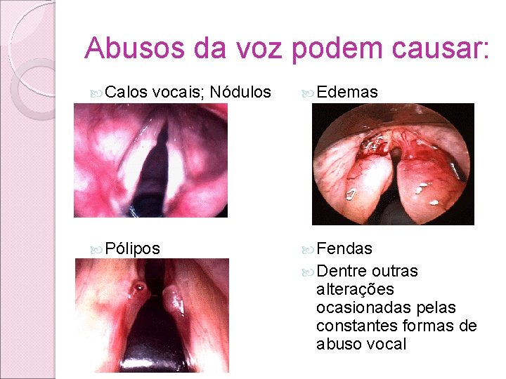 Abusos da voz podem causar: Calos vocais; Nódulos Edemas Pólipos Fendas Dentre outras alterações Abusos da voz podem causar: Calos vocais; Nódulos Edemas Pólipos Fendas Dentre outras alterações