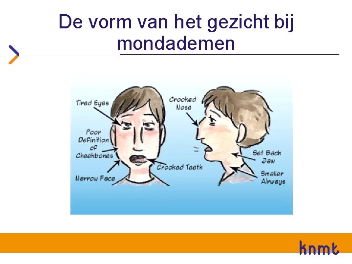 De vorm van het gezicht bij mondademen 