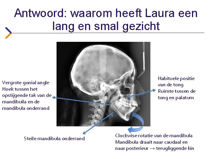 Antwoord: waarom heeft Laura een lang en smal gezicht Vergrote gonial angle Hoek tussen