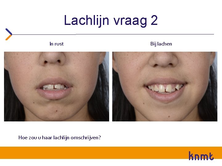 Lachlijn vraag 2 In rust Hoe zou u haar lachlijn omschrijven? Bij lachen Lachlijn vraag 2 In rust Hoe zou u haar lachlijn omschrijven? Bij lachen