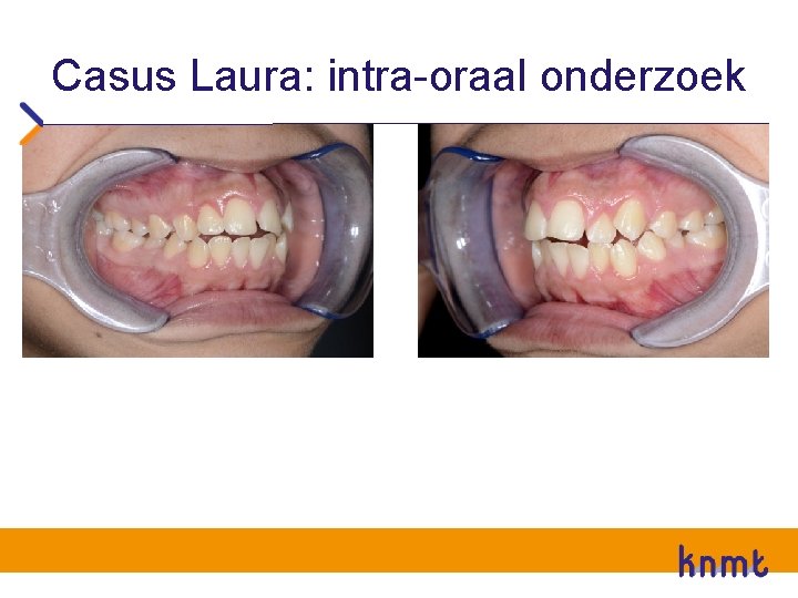 Casus Laura: intra-oraal onderzoek 