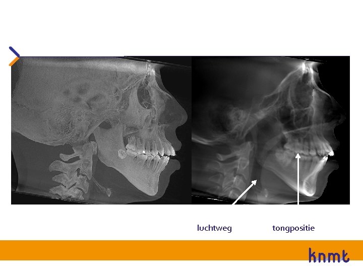 luchtweg tongpositie 