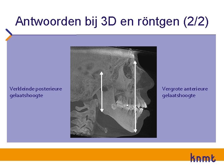 Antwoorden bij 3 D en röntgen (2/2) Verkleinde posterieure gelaatshoogte Vergrote anterieure gelaatshoogte 