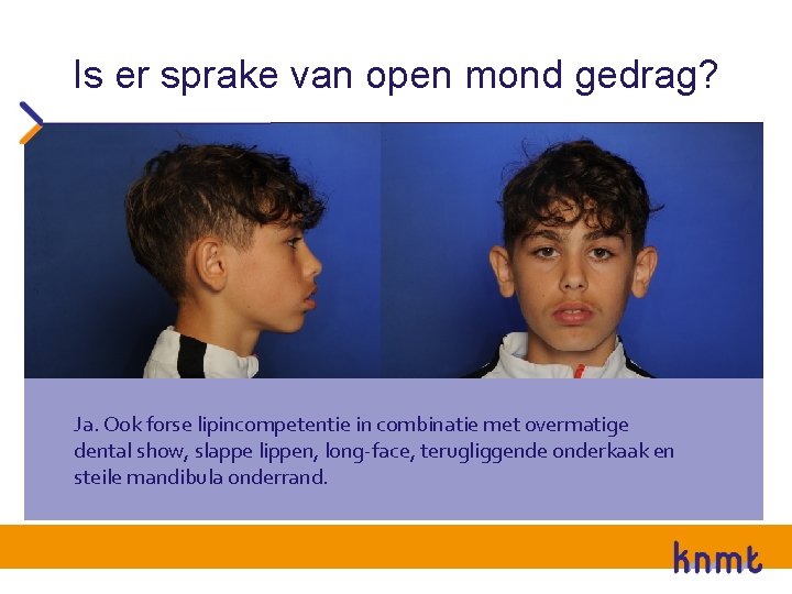 Is er sprake van open mond gedrag? Ja. Ook forse lipincompetentie in combinatie met