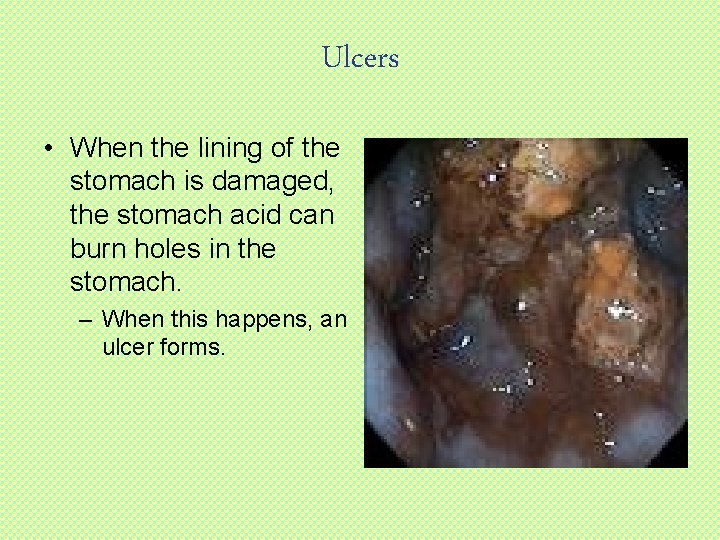 Ulcers • When the lining of the stomach is damaged, the stomach acid can
