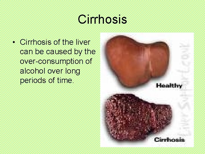 Cirrhosis • Cirrhosis of the liver can be caused by the over-consumption of alcohol