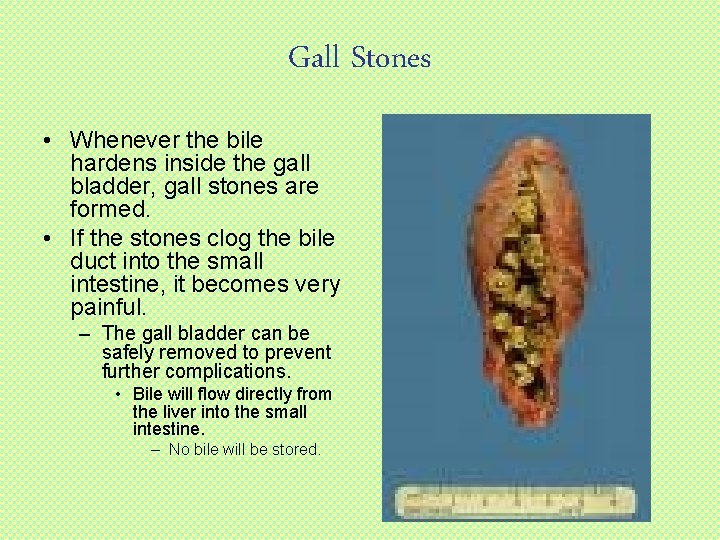 Gall Stones • Whenever the bile hardens inside the gall bladder, gall stones are