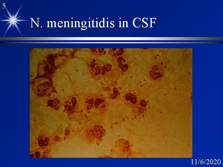 5 N. meningitidis in CSF 11/6/2020 