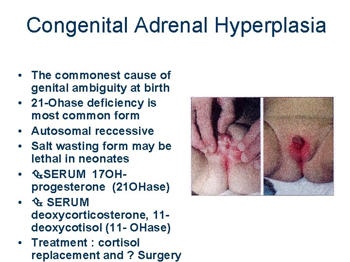 Congenital Adrenal Hyperplasia • The commonest cause of genital ambiguity at birth • 21