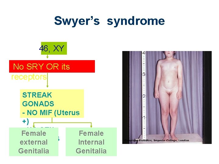 Swyer’s syndrome 46, XY No SRY OR its receptors STREAK GONADS - NO MIF