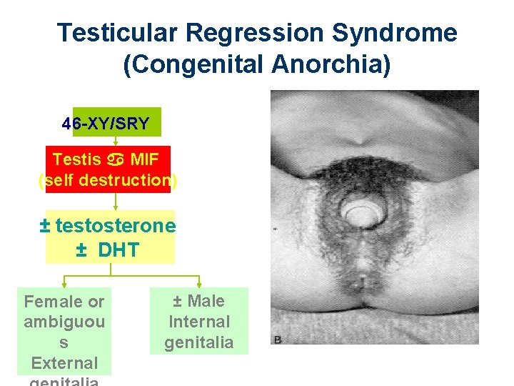 Testicular Regression Syndrome (Congenital Anorchia) 46 -XY/SRY Testis MIF (self destruction) ± testosterone ±