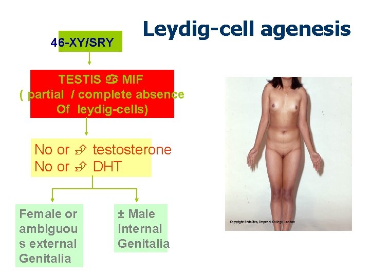 46 -XY/SRY Leydig-cell agenesis TESTIS MIF ( partial / complete absence Of leydig-cells) No