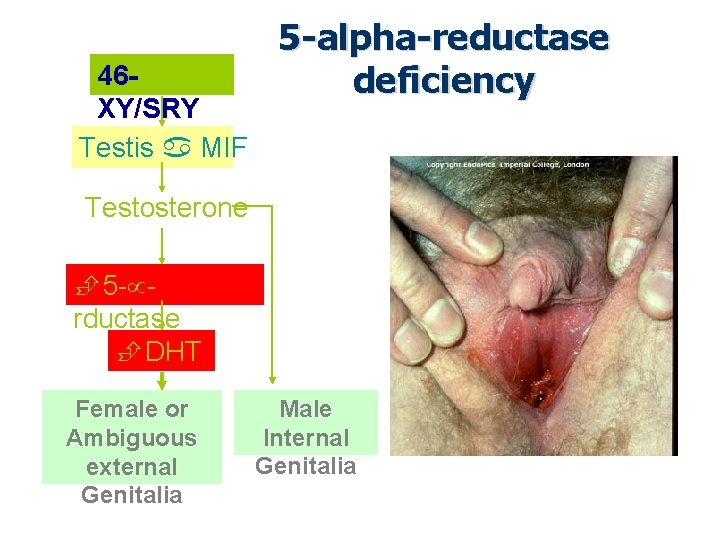 46 XY/SRY Testis MIF 5 -alpha-reductase deficiency Testosterone 5 - rductase DHT Female or