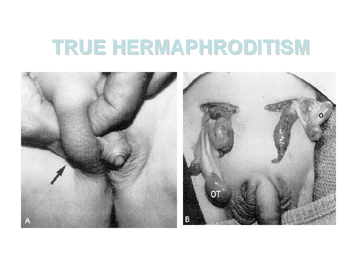 TRUE HERMAPHRODITISM 