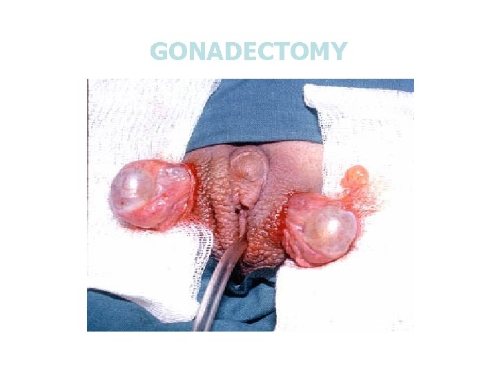 GONADECTOMY 