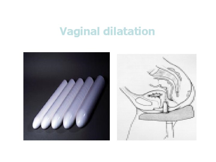 Vaginal dilatation 