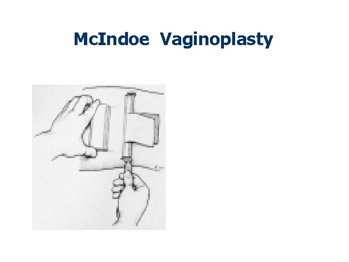 Mc. Indoe Vaginoplasty 