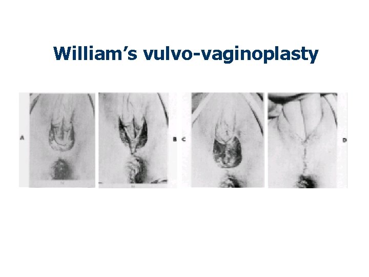 William’s vulvo-vaginoplasty 
