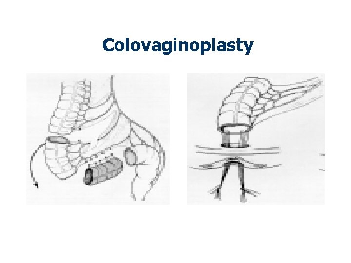 Colovaginoplasty 