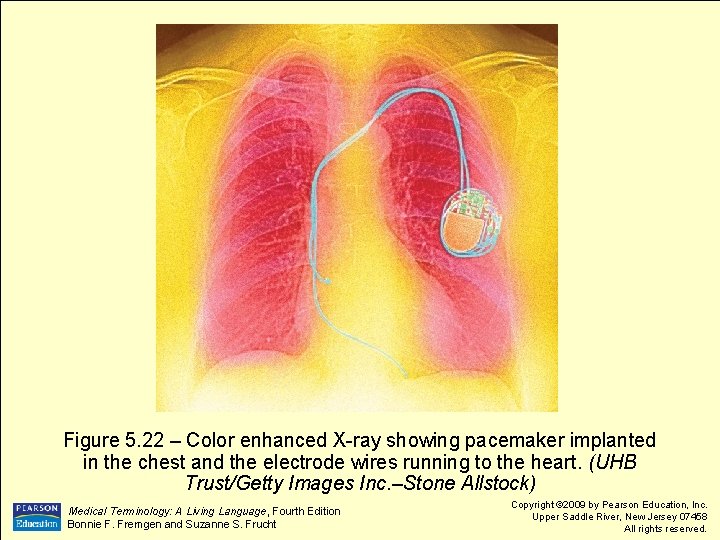 Figure 5. 22 – Color enhanced X-ray showing pacemaker implanted in the chest and