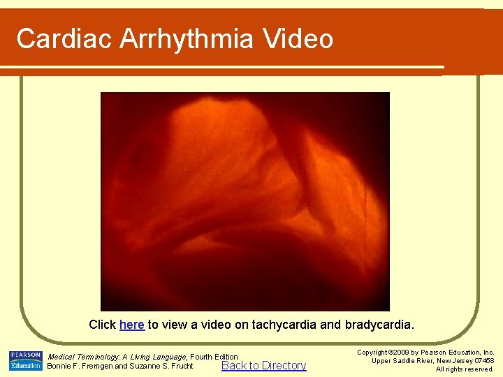 Cardiac Arrhythmia Video Click here to view a video on tachycardia and bradycardia. Medical