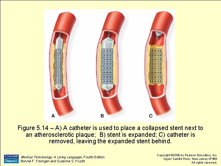 Figure 5. 14 – A) A catheter is used to place a collapsed stent