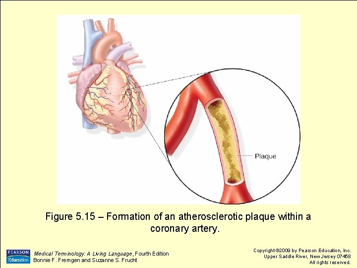 Figure 5. 15 – Formation of an atherosclerotic plaque within a coronary artery. Medical