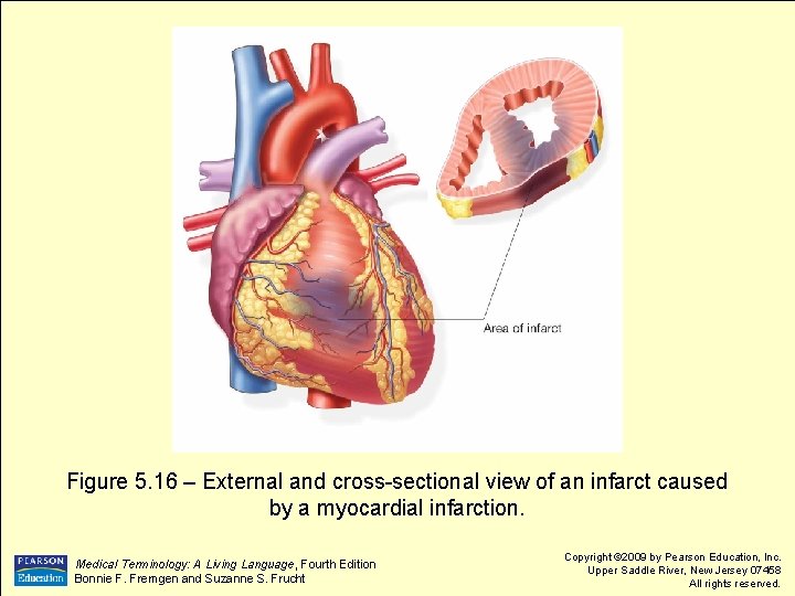 Figure 5. 16 – External and cross-sectional view of an infarct caused by a