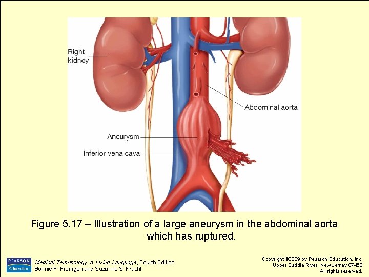 Figure 5. 17 – Illustration of a large aneurysm in the abdominal aorta which