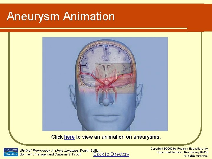 Aneurysm Animation Click here to view an animation on aneurysms. Medical Terminology: A Living
