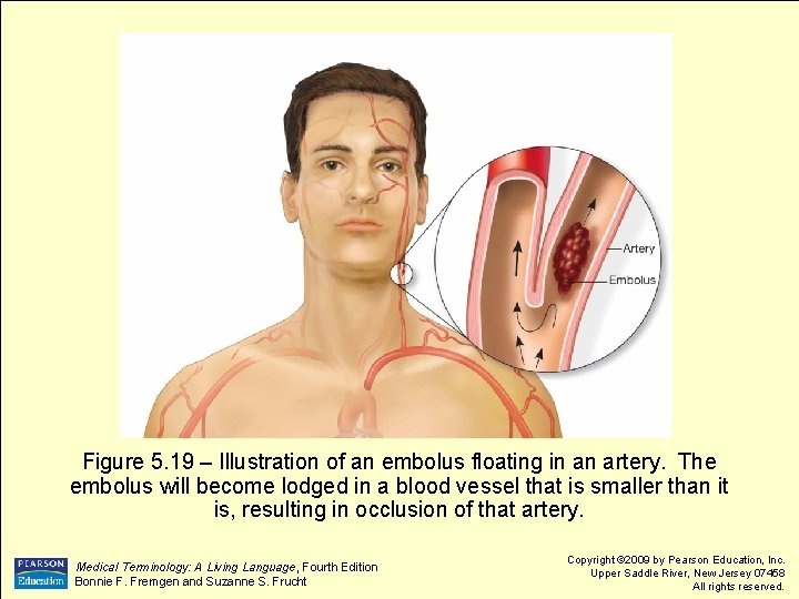 Figure 5. 19 – Illustration of an embolus floating in an artery. The embolus