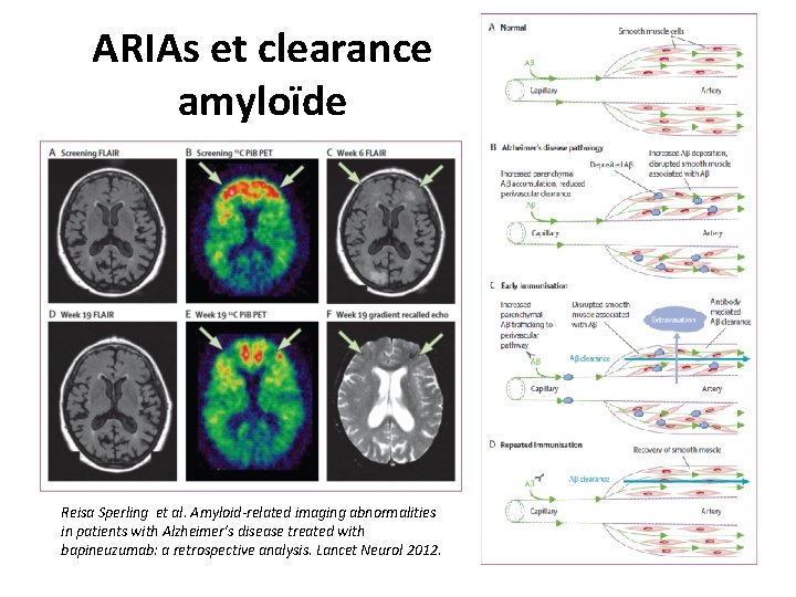 ARIAs et clearance amyloïde Reisa Sperling et al. Amyloid-related imaging abnormalities in patients with