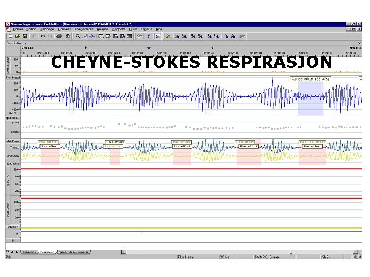 CHEYNE-STOKES RESPIRASJON 