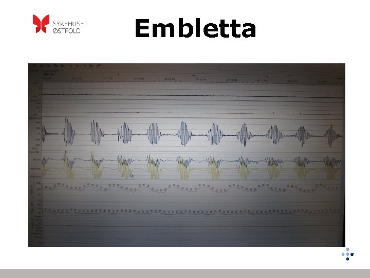 Embletta 