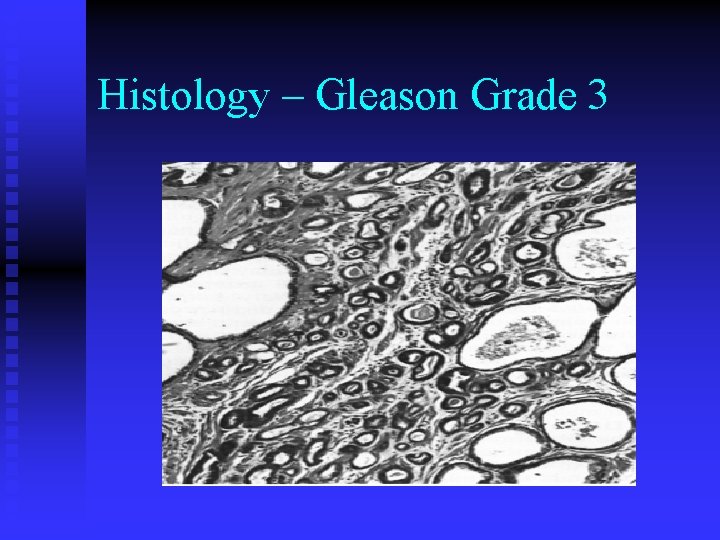 Histology – Gleason Grade 3 Histology – Gleason Grade 3