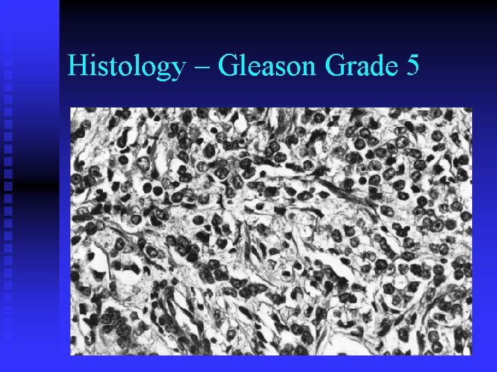 Histology – Gleason Grade 5 Histology – Gleason Grade 5