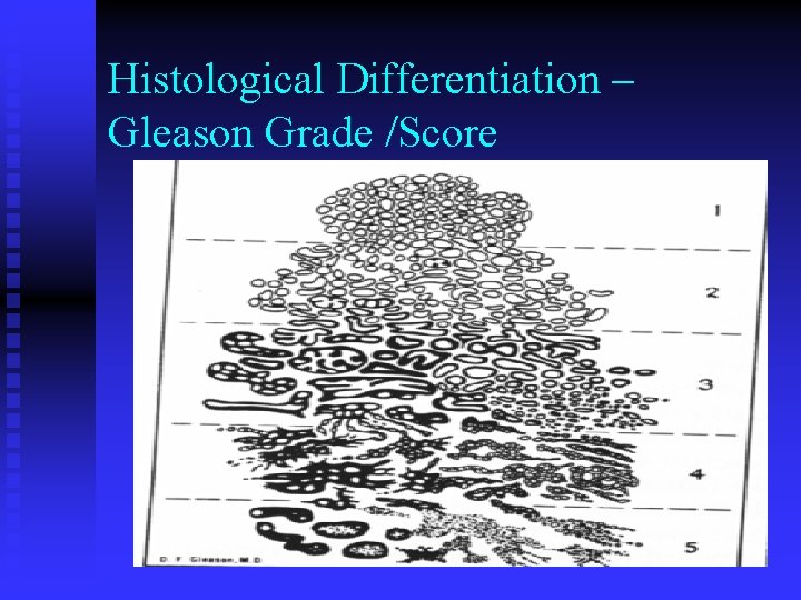 Histological Differentiation – Gleason Grade /Score Histological Differentiation – Gleason Grade /Score
