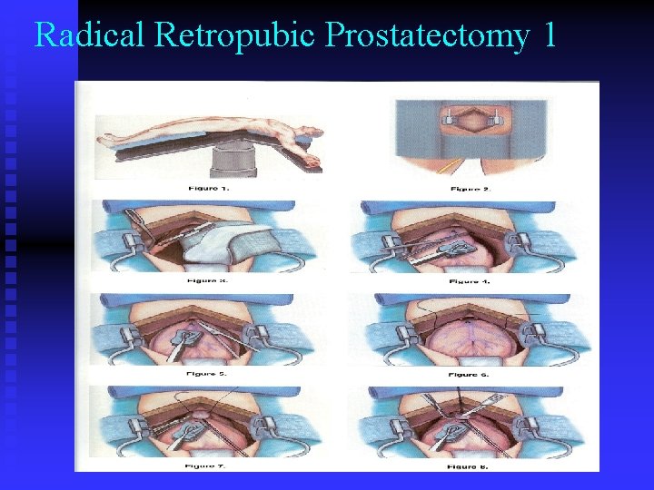 Radical Retropubic Prostatectomy 1 Radical Retropubic Prostatectomy 1
