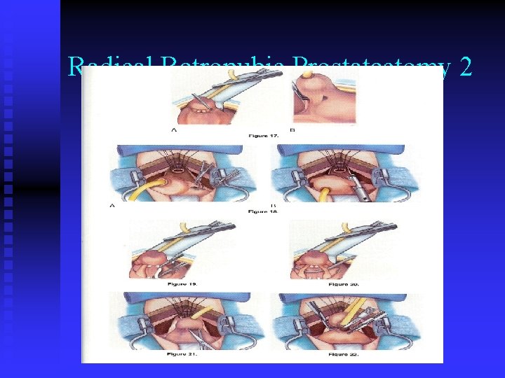 Radical Retropubic Prostatectomy 2 Radical Retropubic Prostatectomy 2