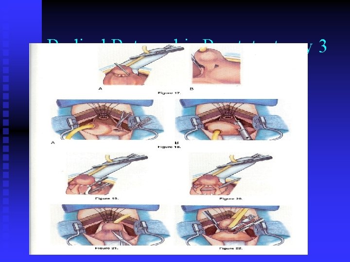 Radical Retropubic Prostatectomy 3 Radical Retropubic Prostatectomy 3