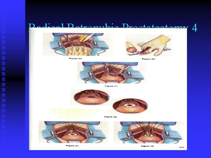 Radical Retropubic Prostatectomy 4 Radical Retropubic Prostatectomy 4