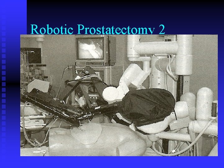 Robotic Prostatectomy 2 Robotic Prostatectomy 2