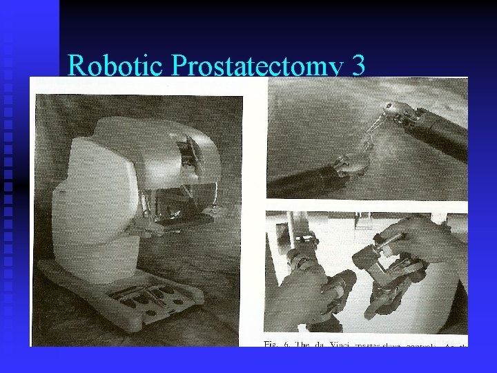 Robotic Prostatectomy 3 Robotic Prostatectomy 3