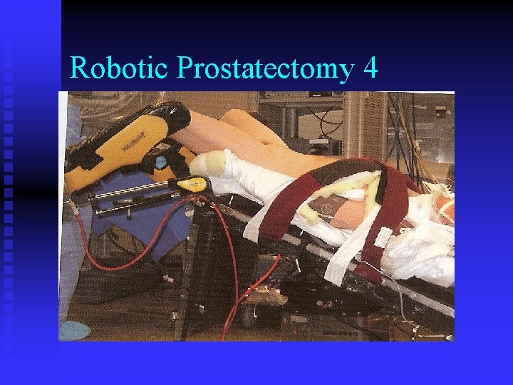 Robotic Prostatectomy 4 Robotic Prostatectomy 4