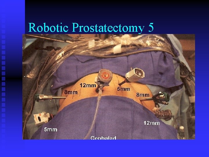 Robotic Prostatectomy 5 Robotic Prostatectomy 5
