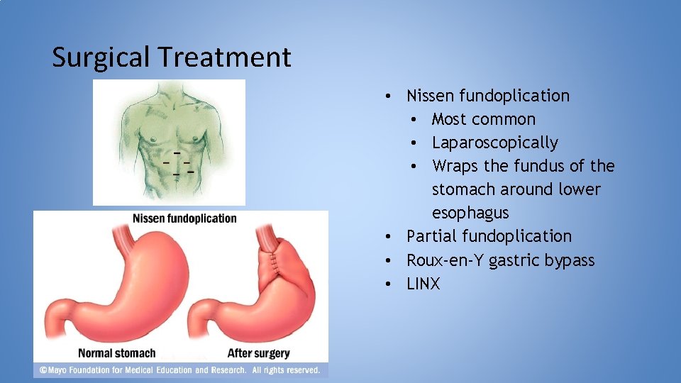 Surgical Treatment • Nissen fundoplication • Most common • Laparoscopically • Wraps the fundus